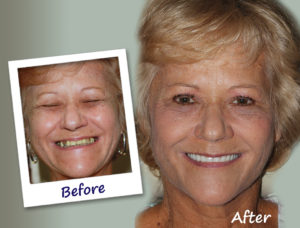 all-on-4 dental implant makeover